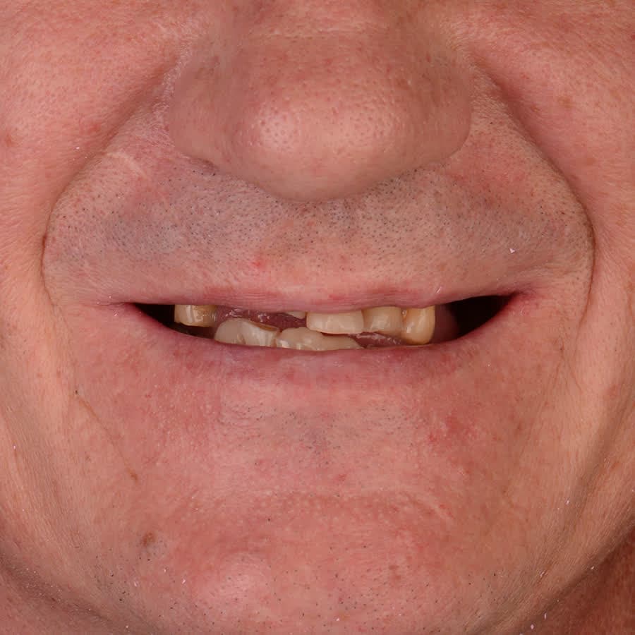 Metamorfoza w ograniczonym czasie — przed leczeniem