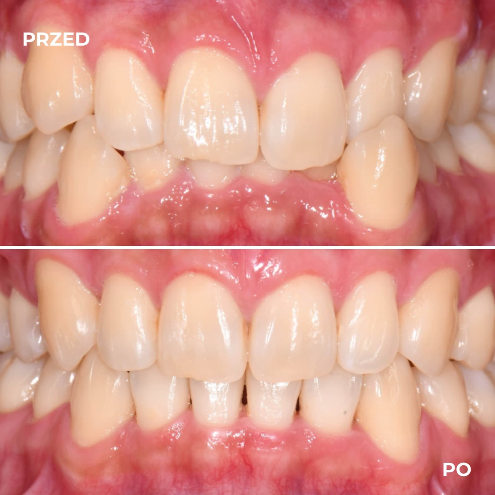 Pacjent — przypadek leczenia Invisalign (przed i po) — przykład 6