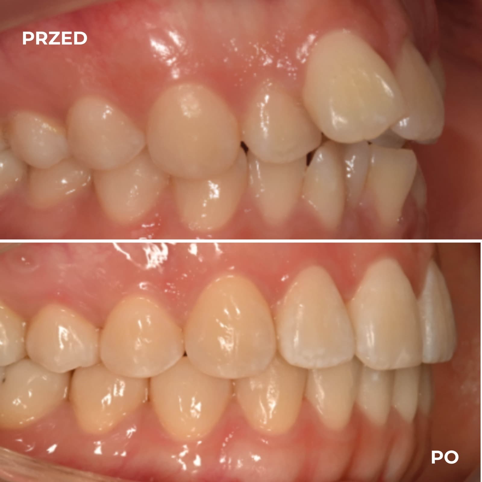 Pacjent — przypadek leczenia Invisalign (przed i po) — przykład 7