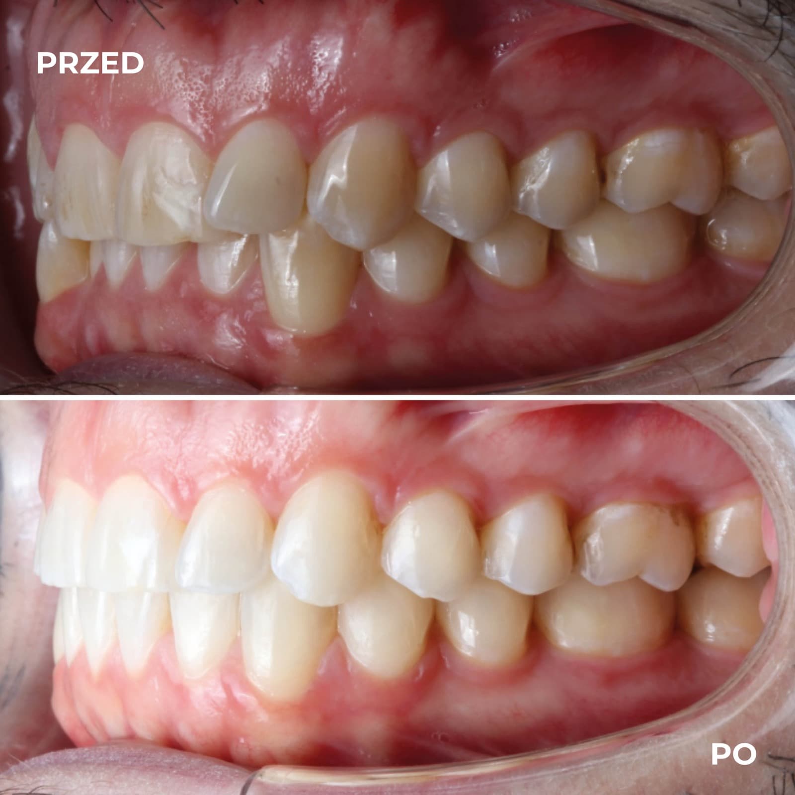 Pacjent — przypadek leczenia Invisalign (przed i po) — przykład 1