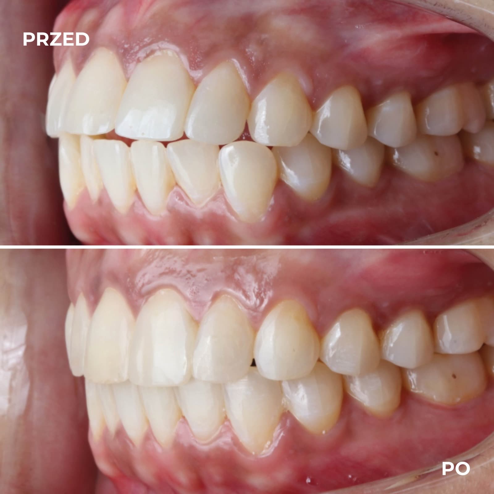 Pacjent — przypadek leczenia Invisalign (przed i po) — przykład 2