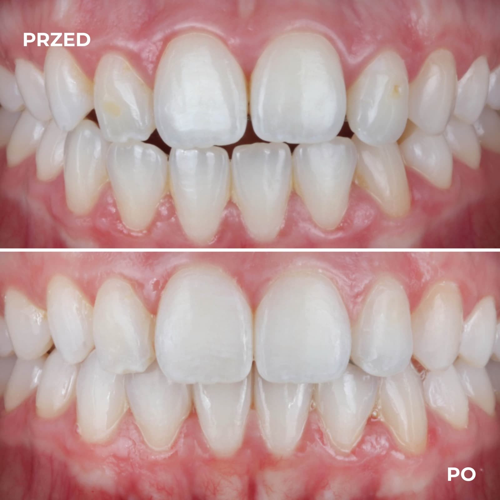 Pacjent — przypadek leczenia Invisalign (przed i po) — przykład 3
