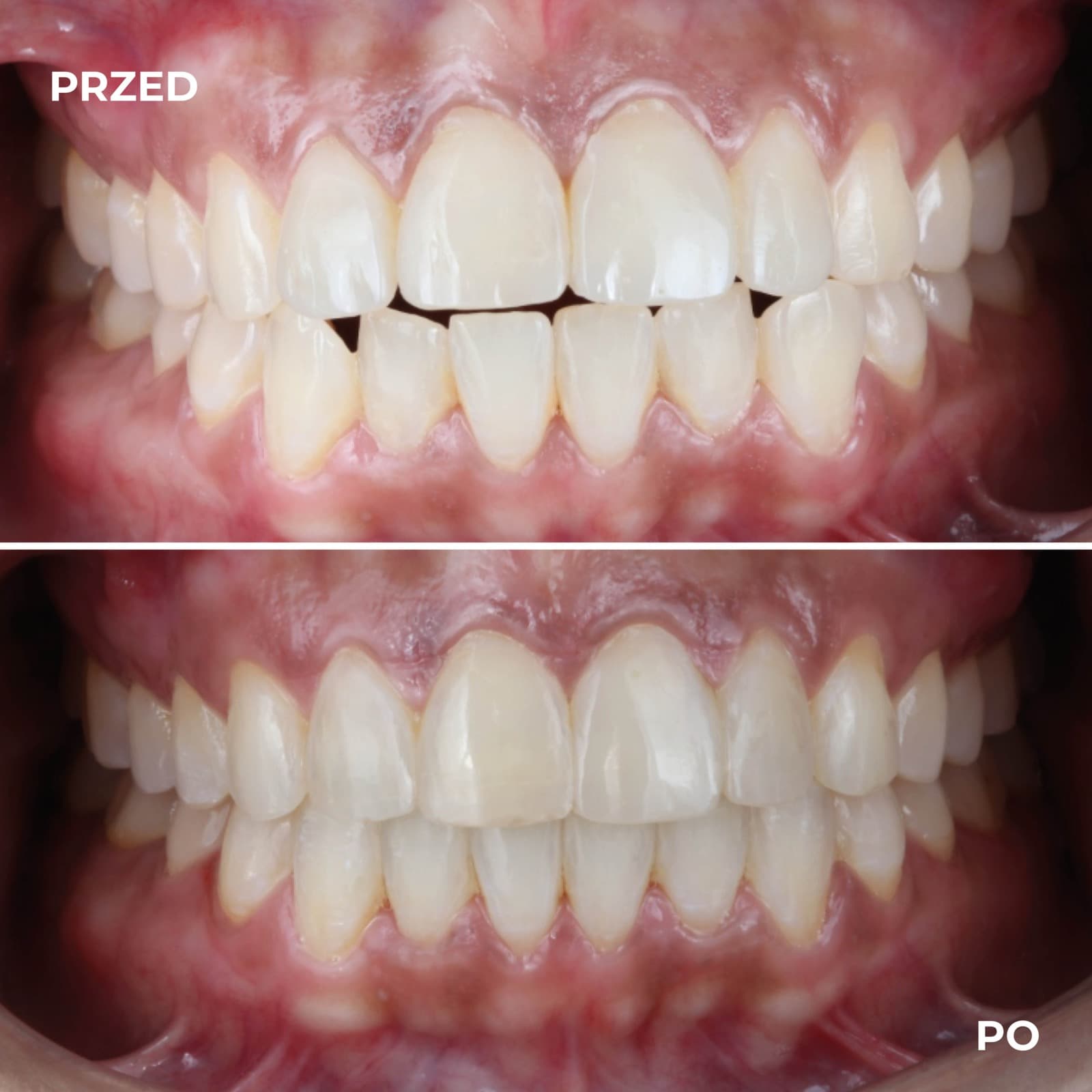 Pacjent — przypadek leczenia Invisalign (przed i po) — przykład 4