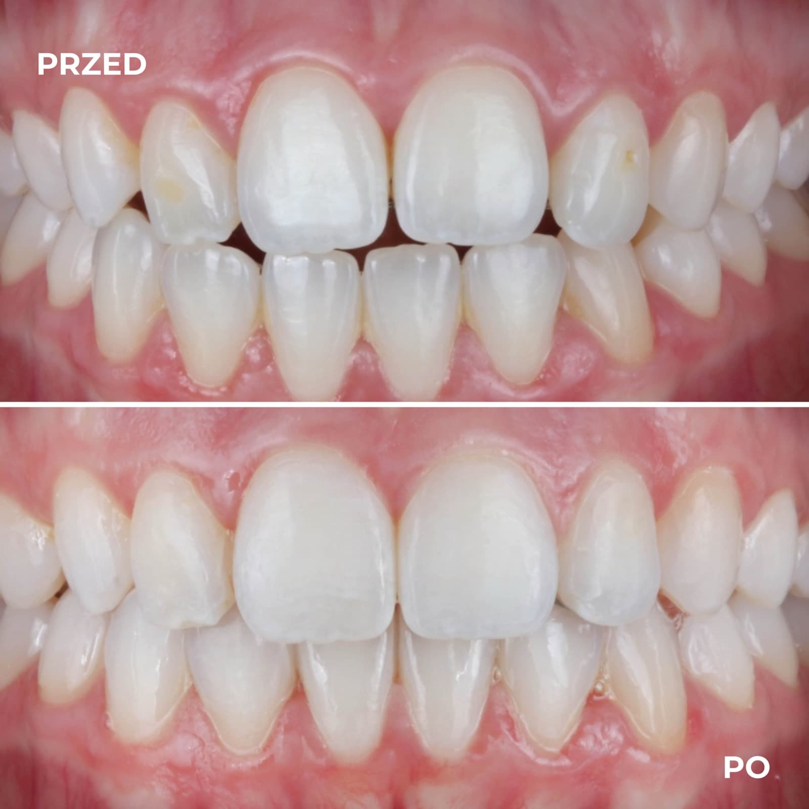 Pacjent — przypadek leczenia Invisalign (przed i po) — przykład 5