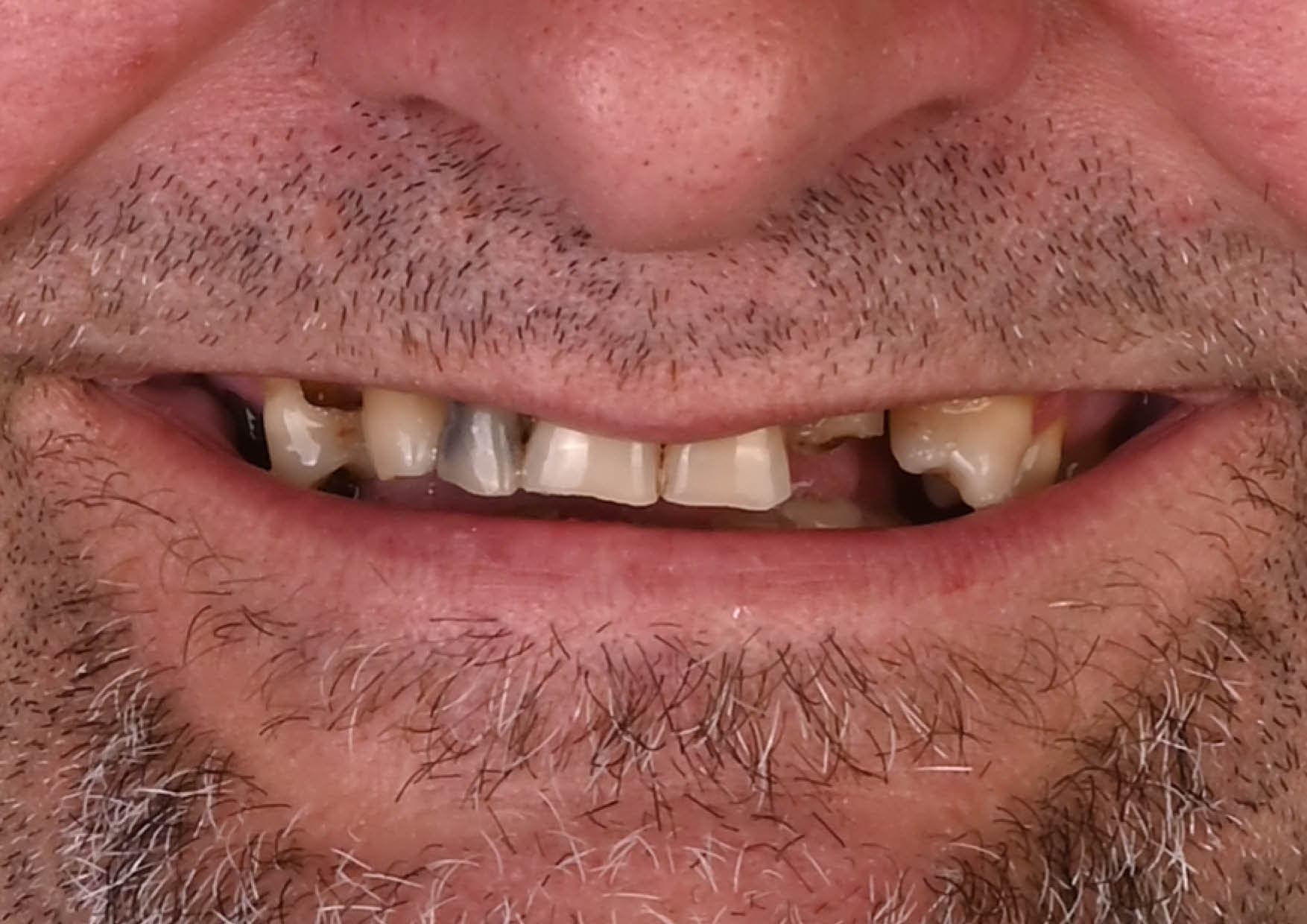 Całościowa odbudowa na implantach metodą chirurgii jednego dnia — przed leczeniem