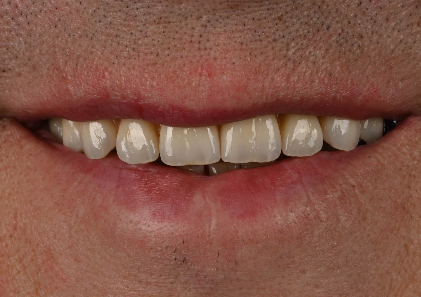 Odbudowa łuku górnego na implantach — po leczeniu