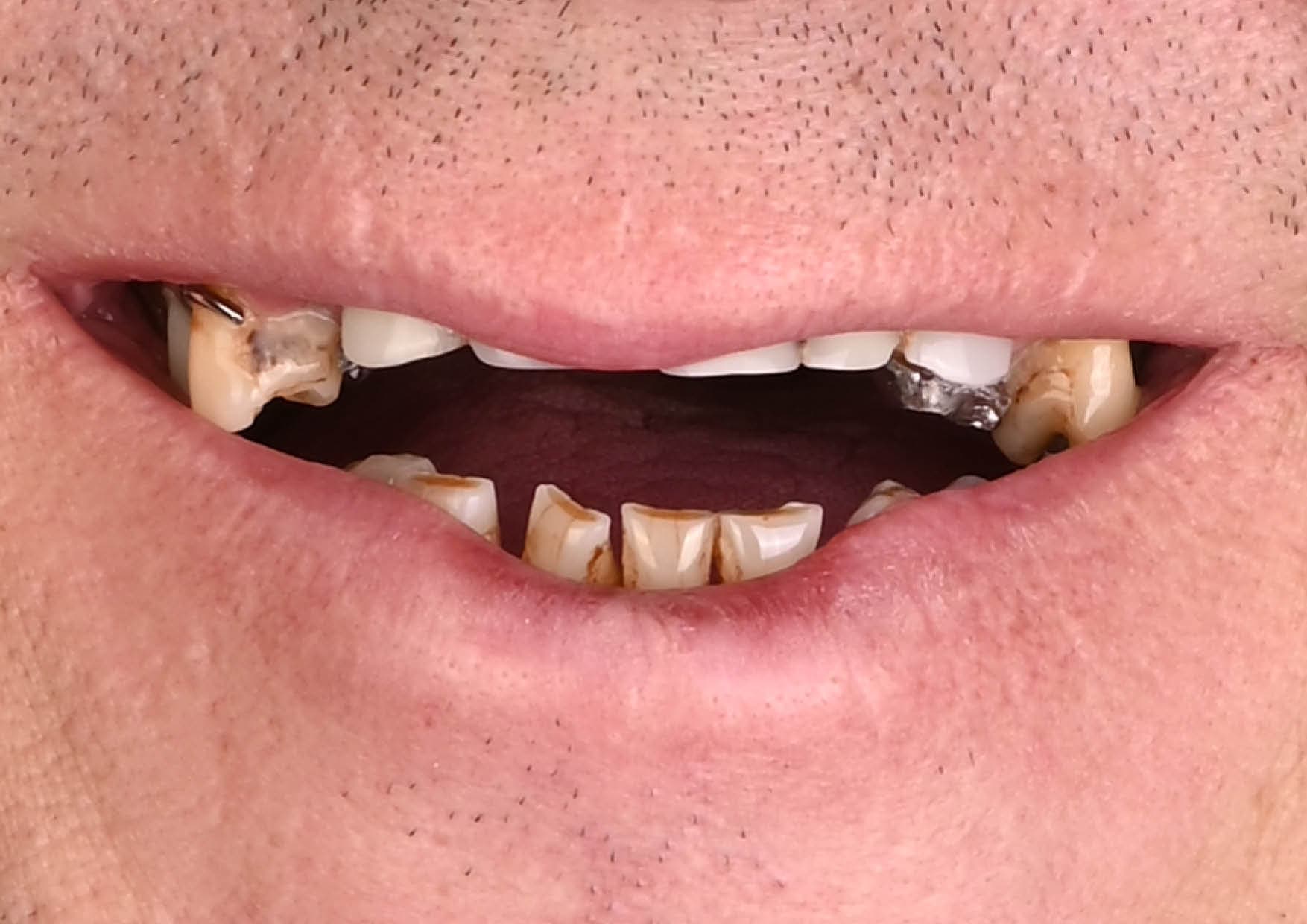 Odbudowa łuku górnego na implantach — przed leczeniem