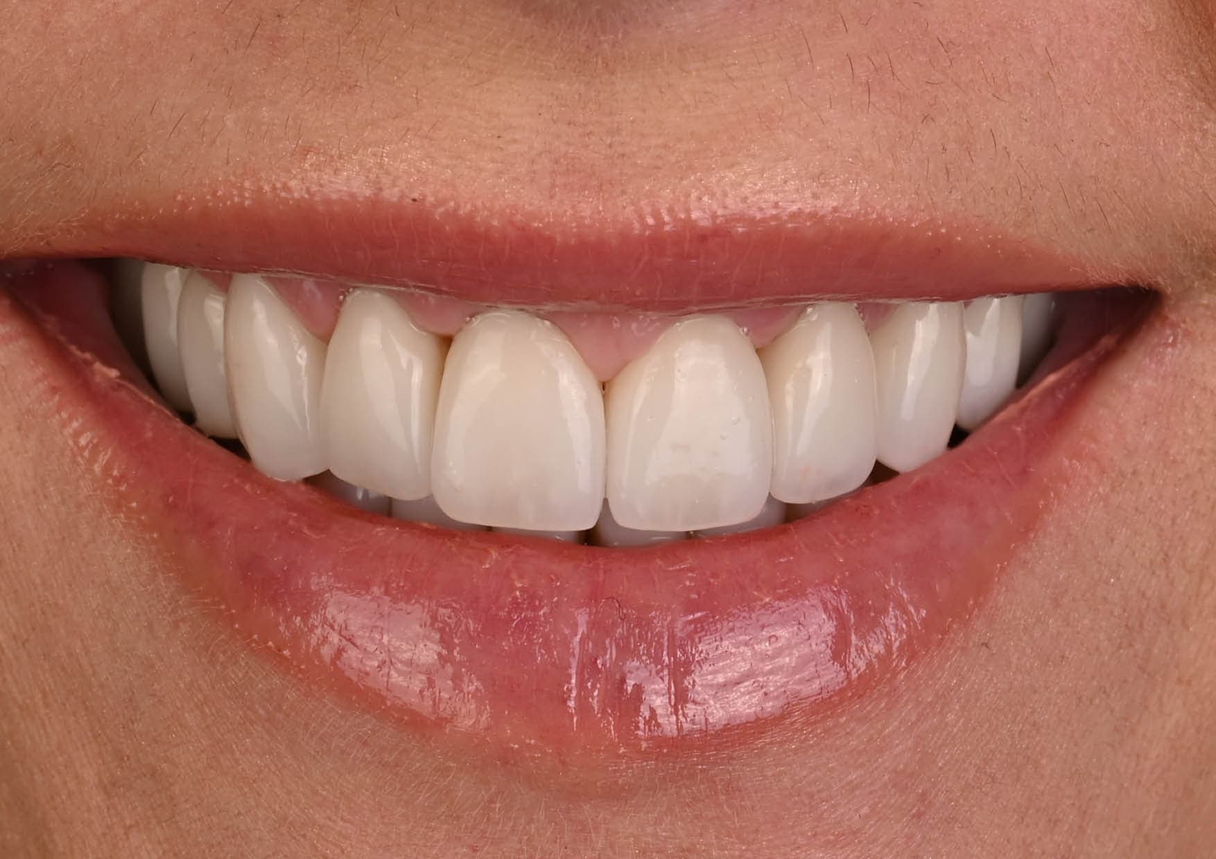 Poprawa estetyki przy zębach startych i brakach zębowych — po leczeniu